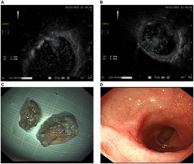 Same duodenal neuroendocrine tumors, different endoscopic resection methods: a case report and literature review